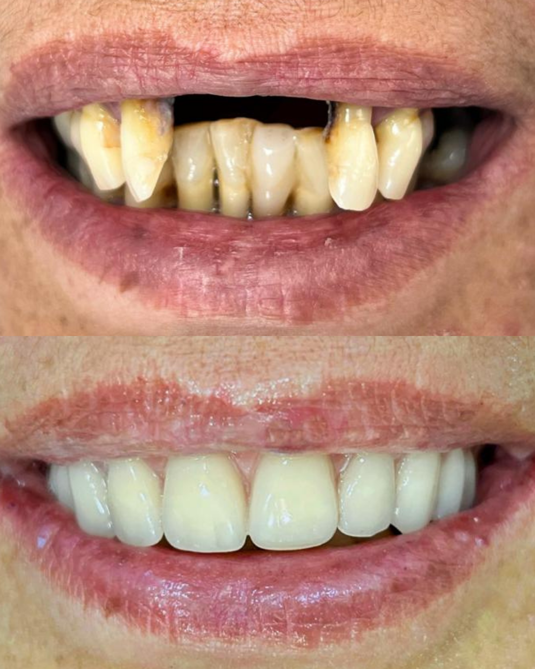 Transformação de sorriso 1: antes e depois