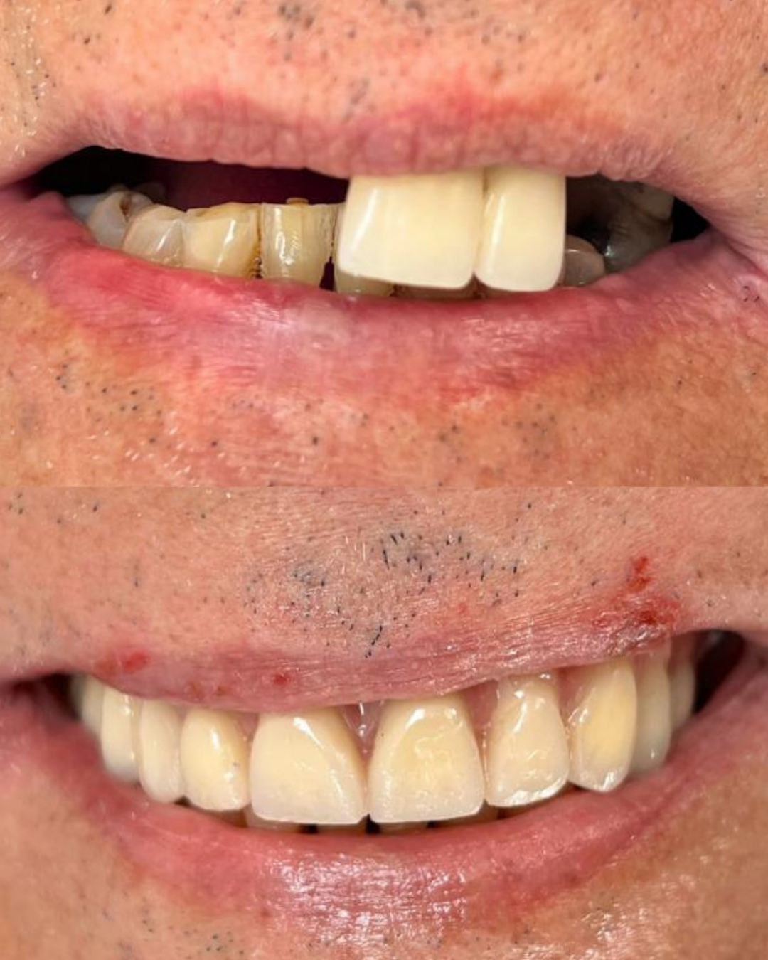Transformação de sorriso 3: antes e depois