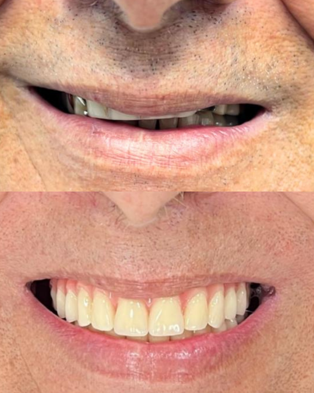 Transformação de sorriso 2: antes e depois