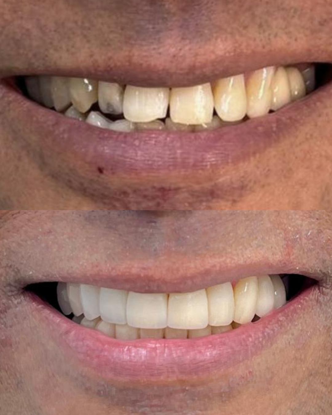 Transformação de sorriso 4: antes e depois
